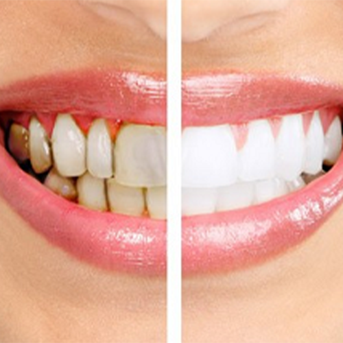 Gainesville Dental Arts Remove Plaque And Tartar