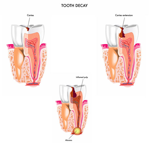 Gainesville Dental Arts Tooth Decay Pain