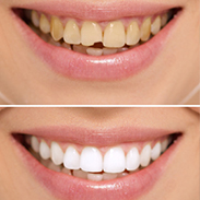 Gainesville Dental Arts Gainesville Haymarket Dental Bonding Related Services