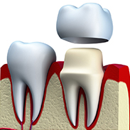 Gainesville Dental Arts Gainesville Haymarket Dental Crown