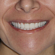 Gainesville Dental Arts Dental Implants Related Services