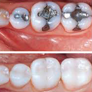Gainesville Dental Arts Gainesville Haymarket Tooth Colored Fillings