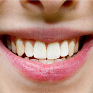 Gainesville Dental Arts Gainesville Haymarket Veneers Related services