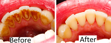 Gainesville Dental Arts Gainesville Haymarket Cosmetic Restorative Implant Bonding Dentistry Before and After