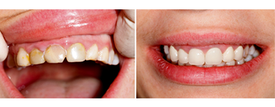 Gainesville Dental Arts Gainesville Haymarket Cosmetic Restorative Implant Bonding Dentistry Before and After