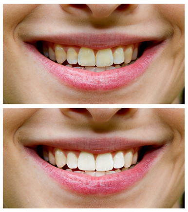 Gainesville Dental Arts Gainesville Haymarket Cosmetic Restorative Implant Bonding Dentistry Before and After