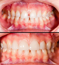 Gainesville Dental Arts Gainesville Haymarket Cosmetic Restorative Implant Bonding Dentistry Before and After