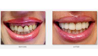 Gainesville Dental Arts Gainesville Haymarket Cosmetic Restorative Implant Bonding Dentistry Before and After