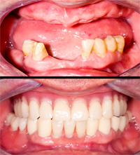 Gainesville Dental Arts Gainesville Haymarket Cosmetic Restorative Implant Bonding Dentistry Before and After