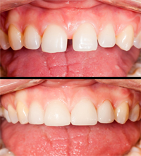 Gainesville Dental Arts Gainesville Haymarket Cosmetic Restorative Implant Bonding Dentistry Before and After