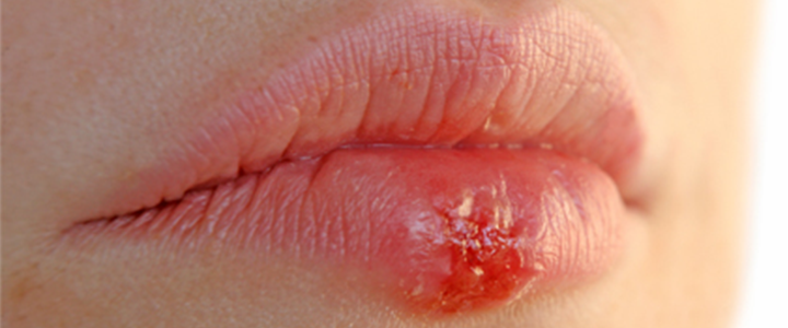 Gainesville Dental Arts Gainesville Haymarket Gentle Coldsore