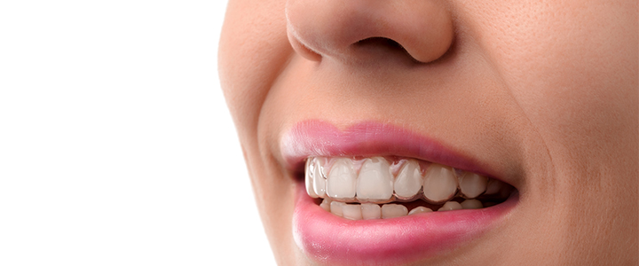 Gainesville Dental Arts Dental Invisalign Services
