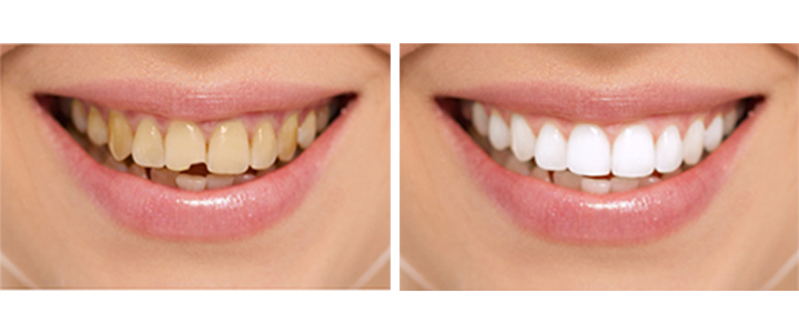 Gainesville Dental Arts Gainesville Haymarket Dental Bonding Cosmetic