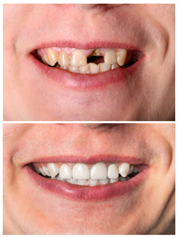 Gainesville Dental Arts Gainesville Haymarket Cosmetic Restorative Bridges Before And After
