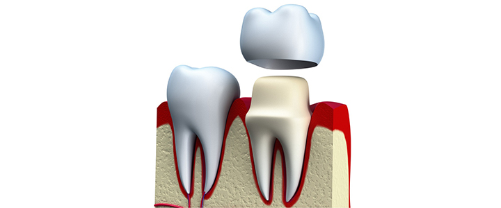 Gainesville Dental Arts Gainesville Haymarket Dental Crown