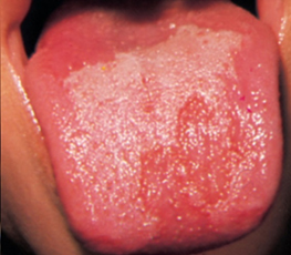 Gainesville Dental Arts Gainesville Haymarket Geographic Tongue