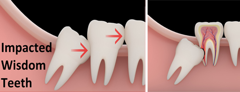 Gainesville Dental Arts Gainesville Haymarket Impacted Wisdom Teeth