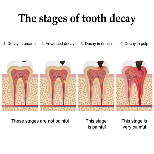 Gainesville Dental Arts Gainesville Haymarket Oral Hygiene Stages Of Caries
