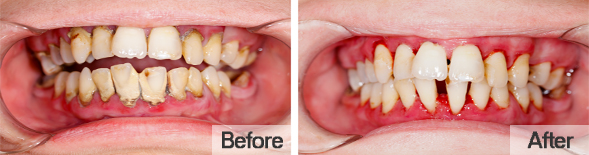 Gainesville Dental Arts Gainesville Haymarket Periodontal Disease