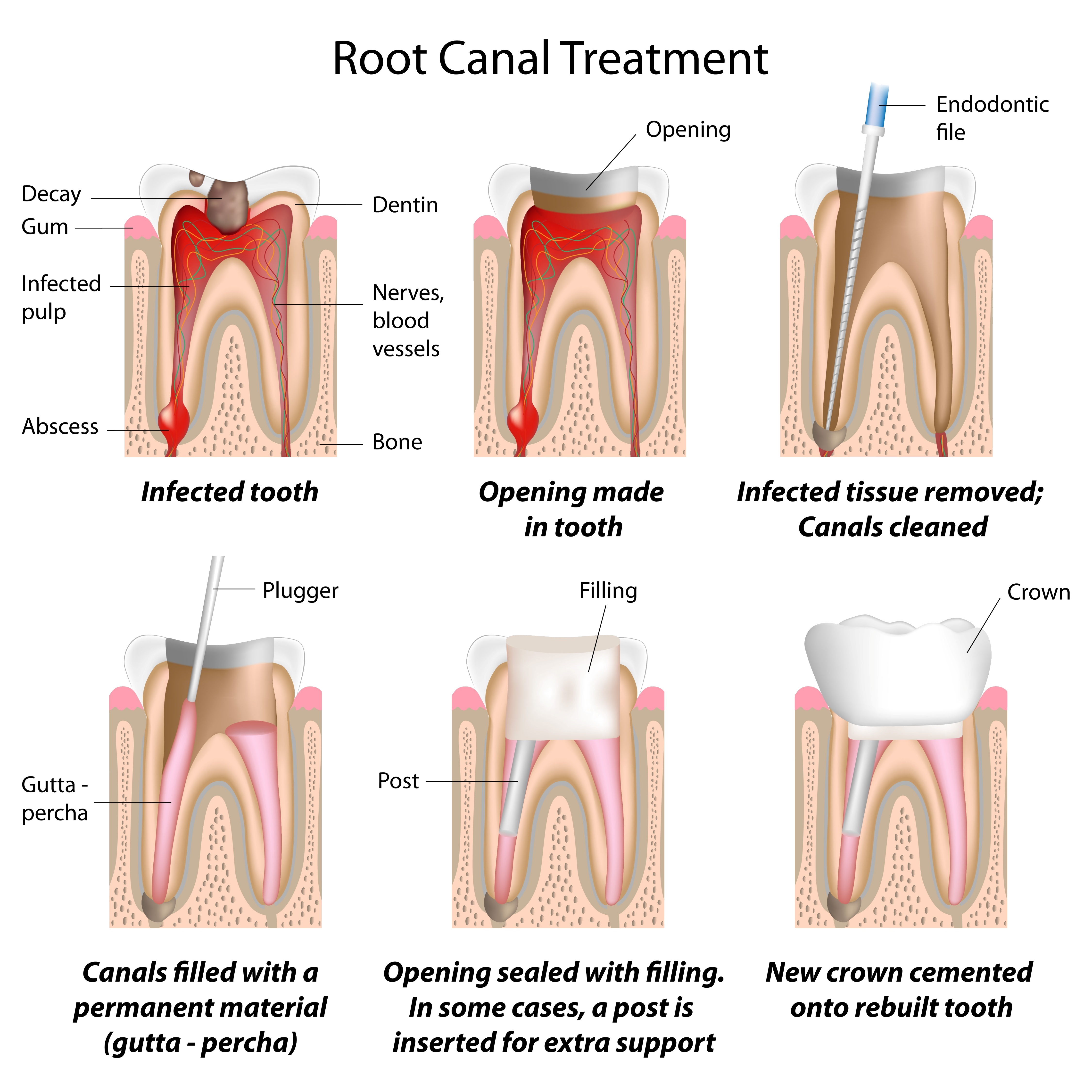 Gainesville Dental Arts Gainesville Haymarket Gentle Root Canal Procedure