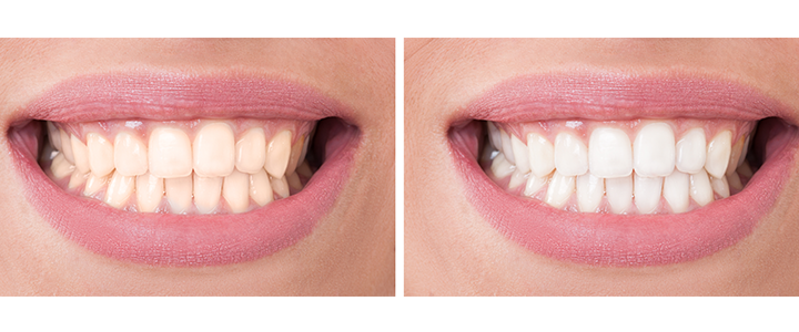 Gainesville Dental Arts Gainesville Haymarket Cosmetic Whitning Before And After