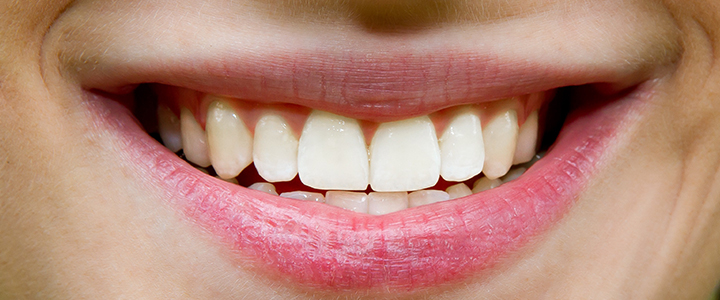 Gainesville Dental Arts Gainesville Haymarket Veneers  Cosmetic services