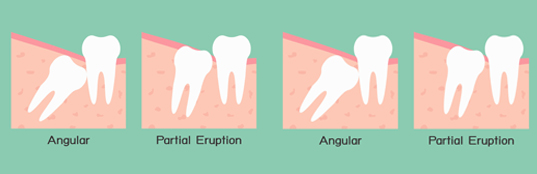 Gainesville Dental Arts Gainesville Haymarket Gentle Professional Wisdom Tooth Extraction