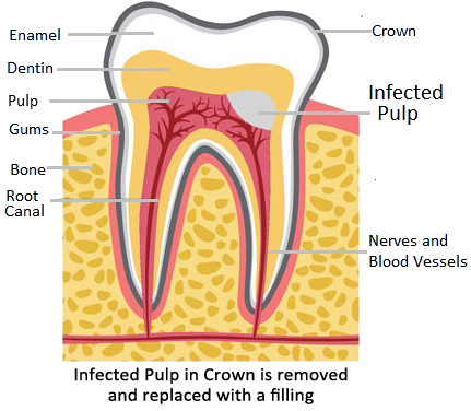 Gainesville Dental Arts Gainesville Haymarket Dental Diagnosing Pulpotomy